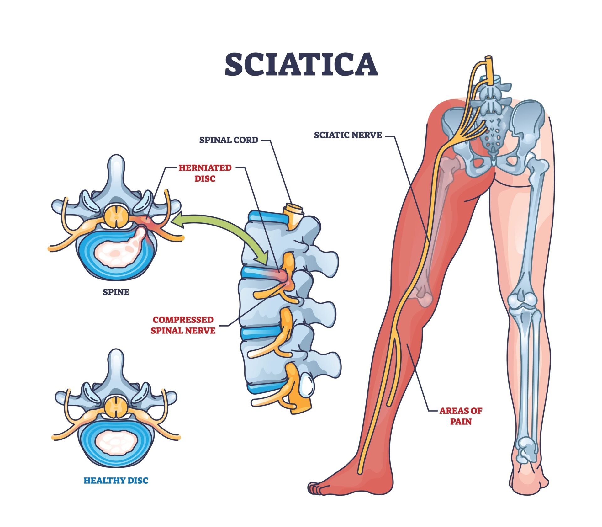 Sciatica illustration
