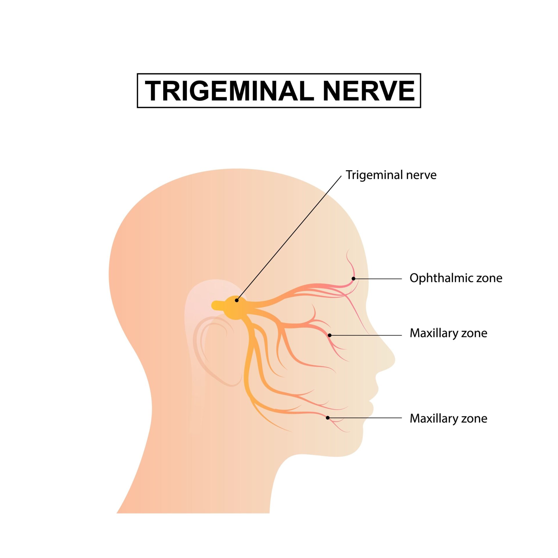 Trigeminal Neuralgia illustration