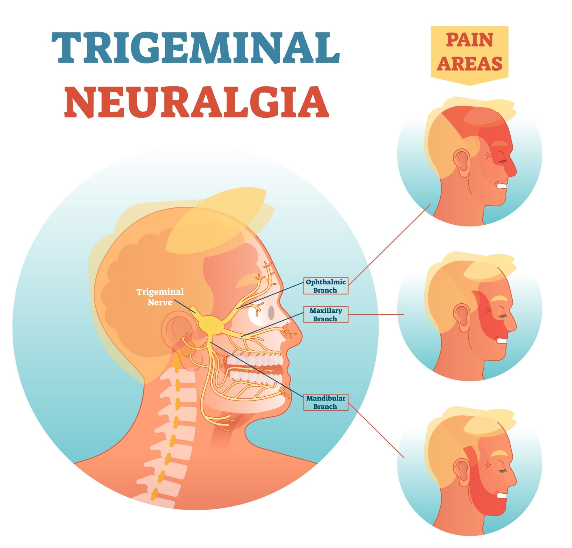 Illustration of Trigeminal Neuralgia and its pain regions
